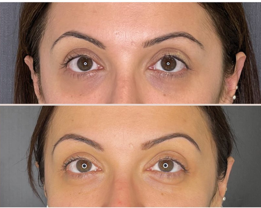 4 Sesiones despigmentante ojeras + GRATIS 2 productos para la zona de las ojeras