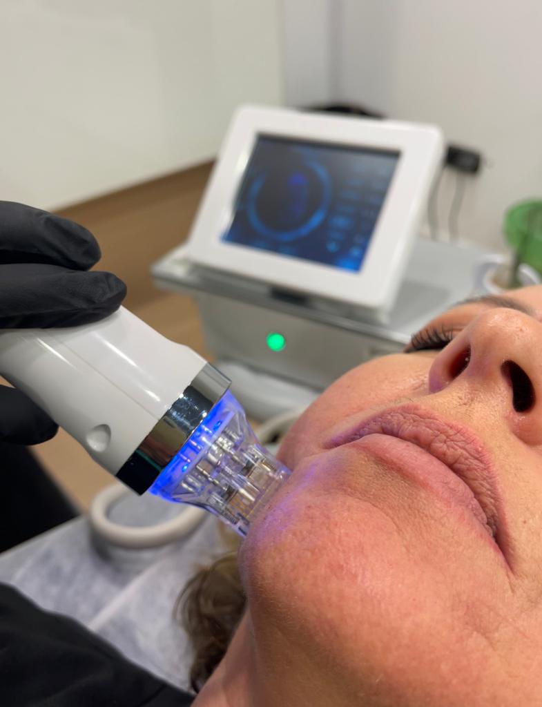 2 Microagujas Fraccionadas x$200